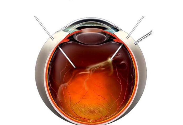 Vitrectomy - Operation for Visa Return